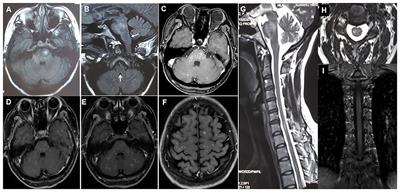 Area Postrema Syndrome: A Rare Feature of Chronic Lymphocytic Inflammation With Pontine Perivascular Enhancement Responsive to Steroids